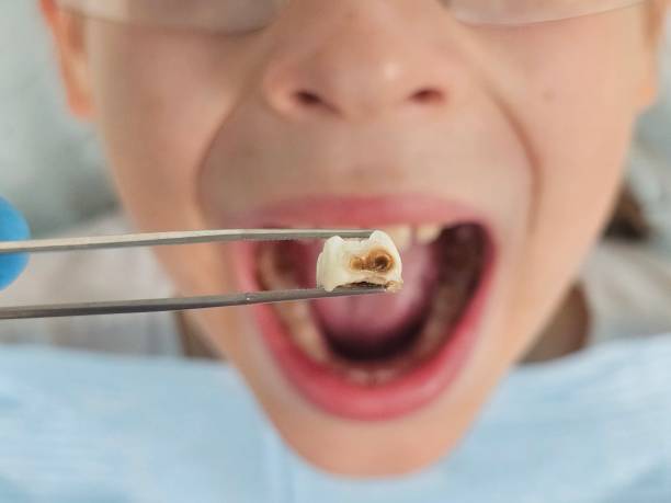 Best Emergency Dentist for Lost Fillings or Crowns in Presquille, LA
